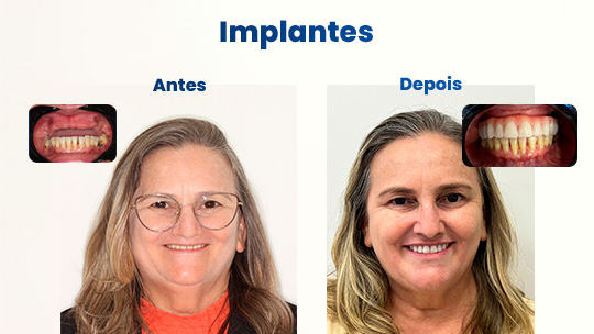 Antes e depois2